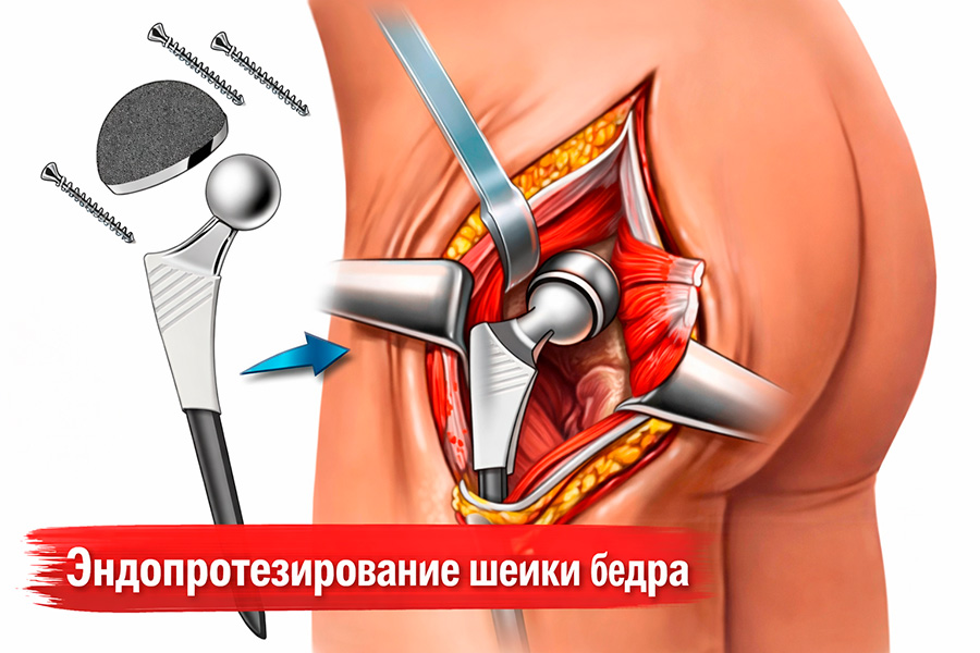 Эндопротезирование шейки бедра у пожилых: восстановление после операции